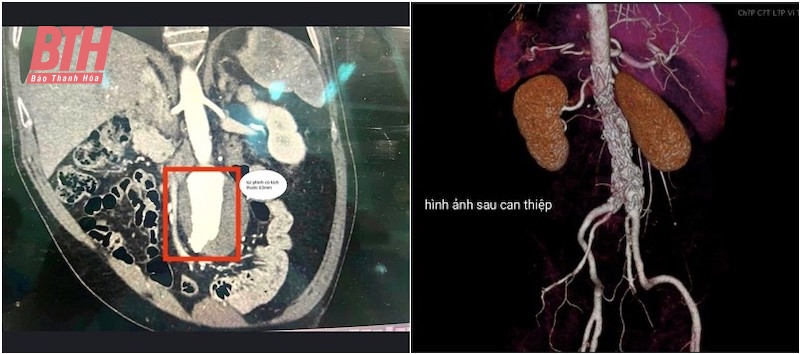 Đặt stent graft cứu sống bệnh nhân phình động mạch chủ bụng doạ vỡ