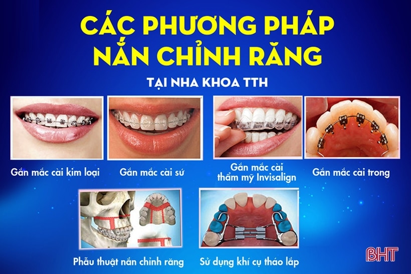 Bệnh viện Đa khoa TTH Hà Tĩnh ưu đãi, hỗ trợ lớn cho dịch vụ niềng răng