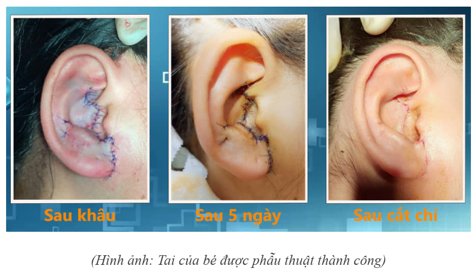 Tạo hình vành tai gần đứt lìa cho bé gái 12 tuổi bị tai nạn giao thông - Ảnh 1.