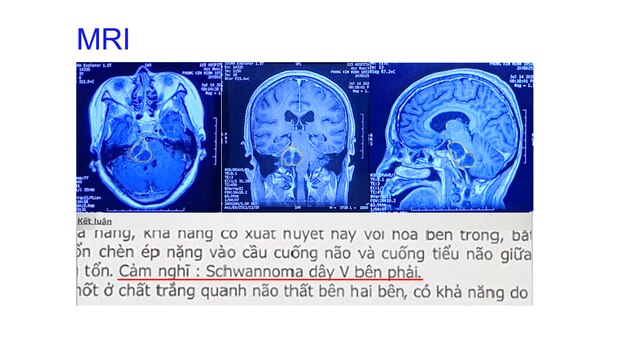 Cứu bệnh nhân u não 'tiên lượng xấu' bằng robot mổ não hiện đại Modus V Synaptive - Ảnh 1.