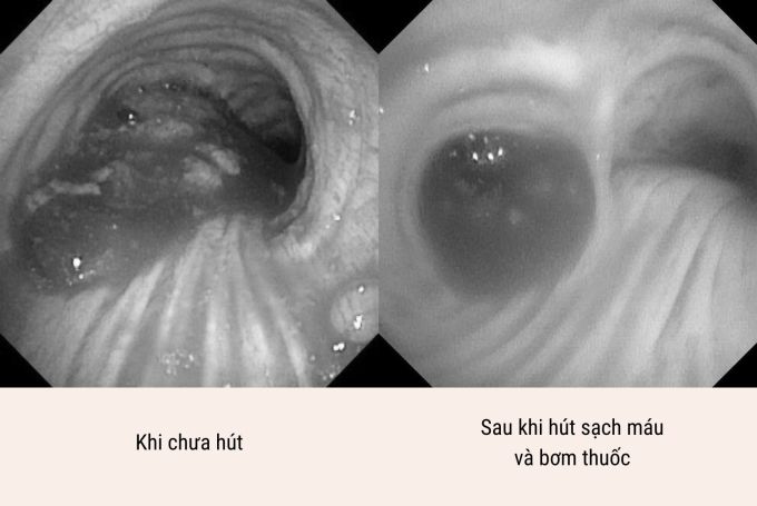 Hình ảnh trước và sau nội soi phế quản hút máu cho người bệnh. Ảnh: BVĐK Tâm Anh