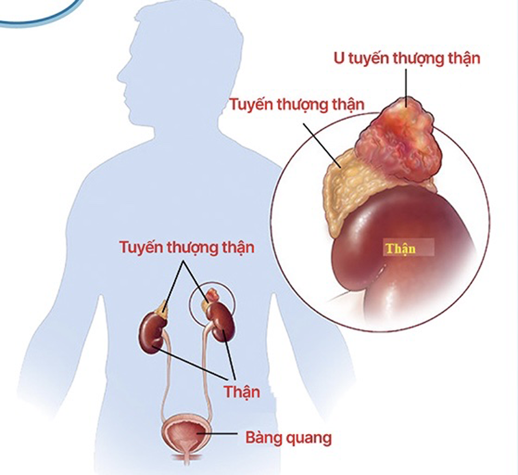 Trẻ bị cao huyết áp do bệnh hiếm  - Ảnh 1.