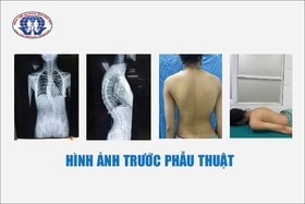 Nắn chỉnh gù vẹo cột sống cho bệnh nhân 15 tuổi