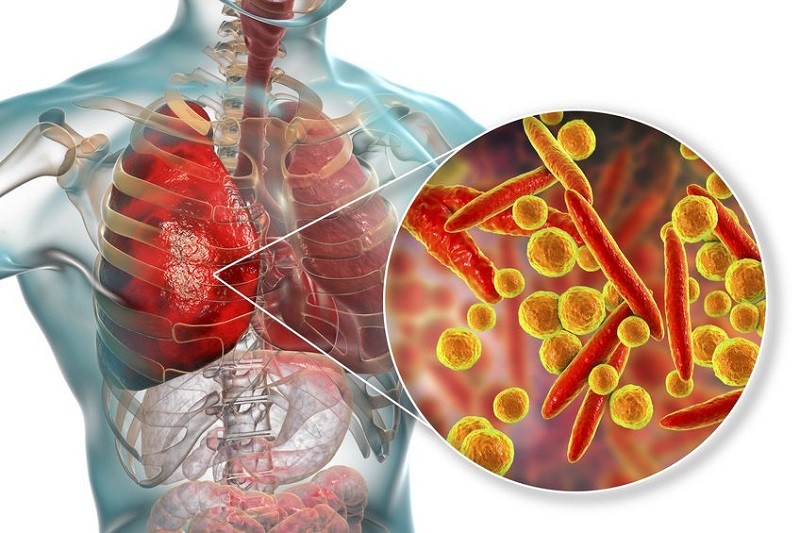 Gia tăng trẻ gặp biến chứng viêm phổi do vi khuẩn mycoplasma pneumoniae