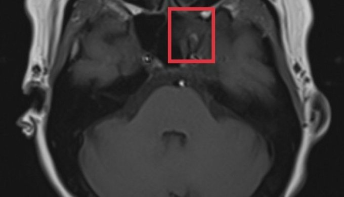 Kết quả chụp MRI ghi nhận khối bất thường tín hiệu vùng niêm mạc hầu mũi trái, xoang bướm trái. Ảnh: Bệnh viện cung cấp