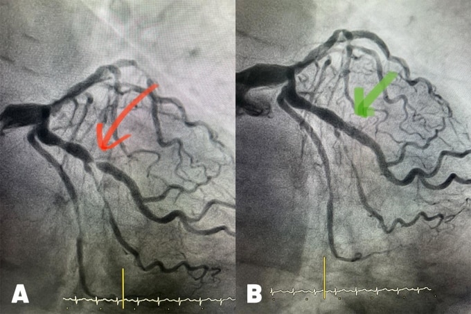 Động mạch liên thất trước của bệnh nhân hẹp 99% (hình A) và sau khi được đặt stent tái thông (hình B). Ảnh: Bệnh viện Tâm Anh