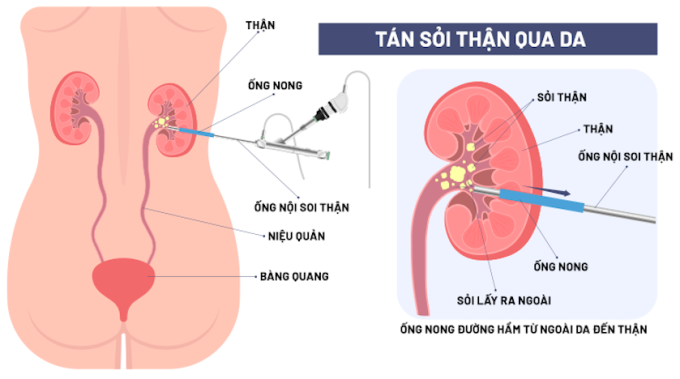 Mô phỏng phương pháp tán sỏi thận qua da. Ảnh: Bệnh viện Đa khoa Tâm Anh