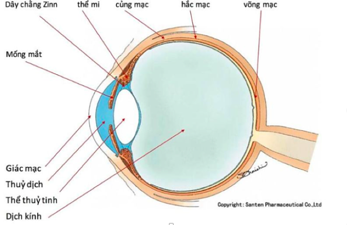 Mô phỏng lệch thuỷ tinh thể, dây chằng Zin bị đứt. Ảnh:Bác sĩ cung cấp