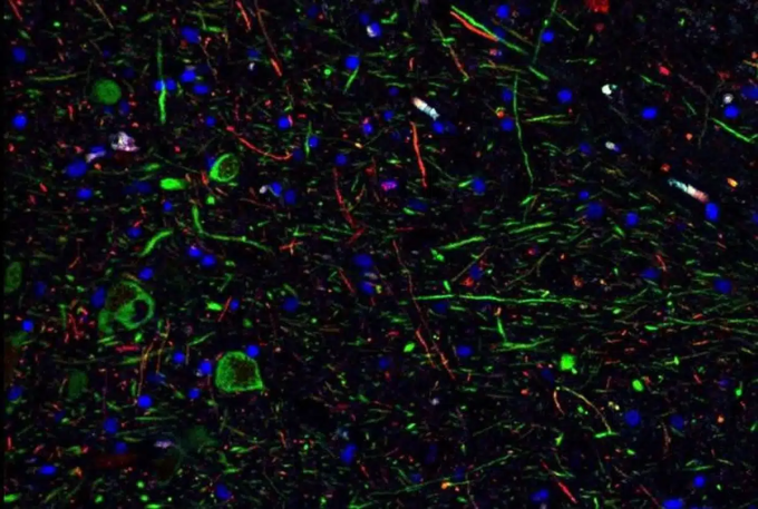 Tế bào thần kinh dopamine (màu xanh lá cây) trong não của các bệnh nhân Covid-19. Ảnh: Liuliu Yang