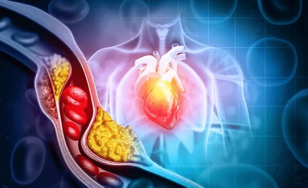 Dấu hiệu cholesterol cao đã chuyển thành bệnh nguy hiểm- Ảnh 1.