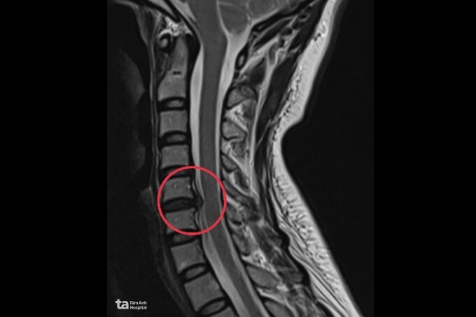 Vị trí đốt sống cổ bị thoát vị của người bệnh. Ảnh: Bệnh viện cung cấp