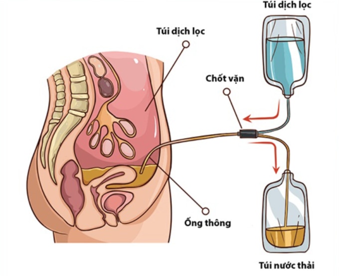 Ảnh minh họa lọc màng bụng. Ảnh: Bệnh viện cung cấp