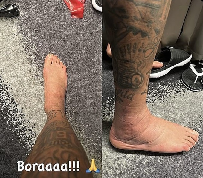 Mắt cá chân sưng tấy của Neymar.