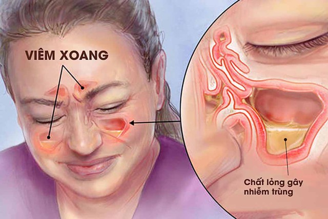 Thời tiết thay đổi, người bị viêm xoang cần làm gì để ngừa tái phát  - Ảnh 3.