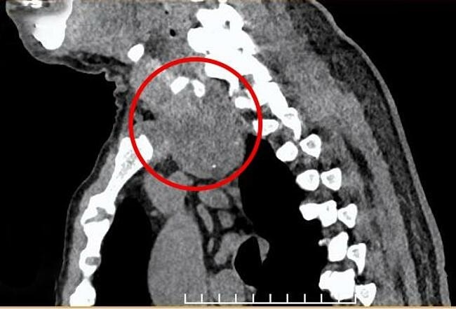 Hình ảnh CT ngực cho thấy bướu giáp sa xuống trung thất. Ảnh: Bệnh viện Tâm Anh