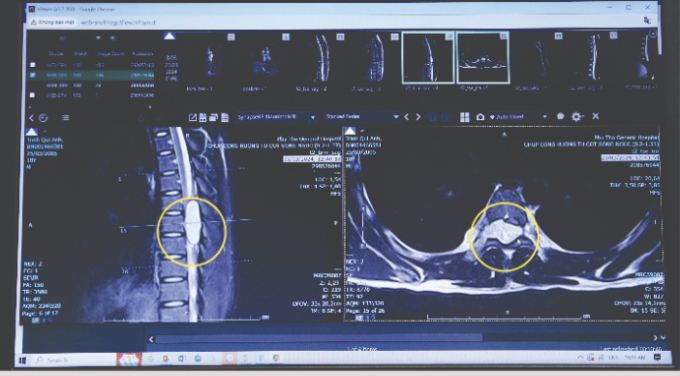 Hình ảnh khối u chèn ép tủy sống gây liệt. Ảnh: Bệnh viện cung cấp