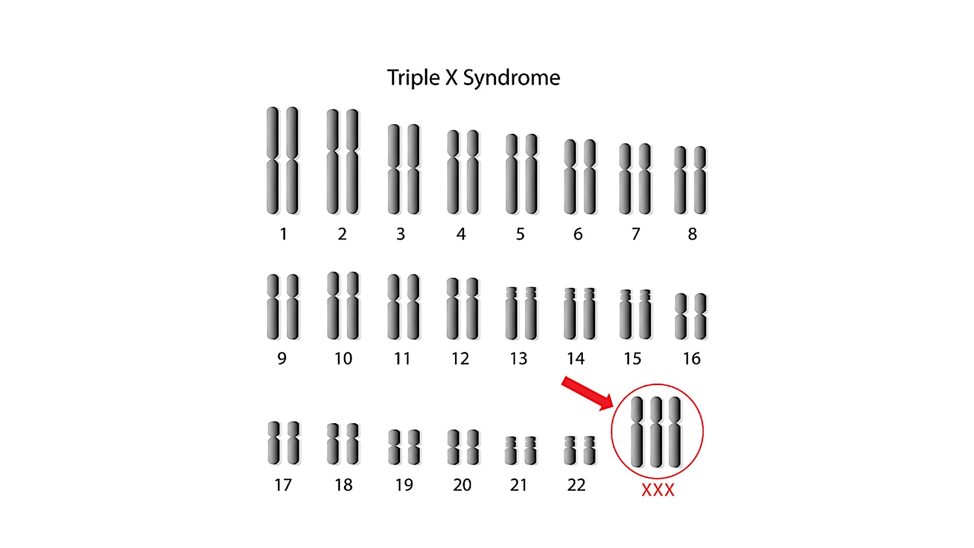 Phụ nữ mắc hội chứng siêu nữ có 3 nhiễm sắc thể X thay vì 2 - Ảnh: STORY MD