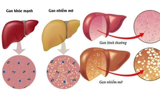 4 cấp độ của bệnh gan nhiễm mỡ, ai không có xin chúc mừng- Ảnh 3.