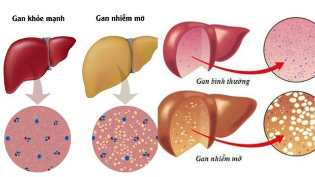 9 món ăn bài thuốc hỗ trợ điều trị bệnh gan nhiễm mỡ hiệu quả nhất- Ảnh 2.