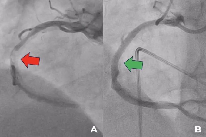 Động mạch vành phải hẹp từ đoạn gần đến đoạn xa gây giới hạn dòng chảy (hình A) và sau khi được đặt stent tái thông (hình B). Ảnh: Bệnh viện Tâm Anh