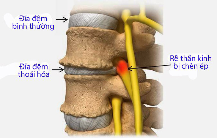 Bệnh đau thắt lưng