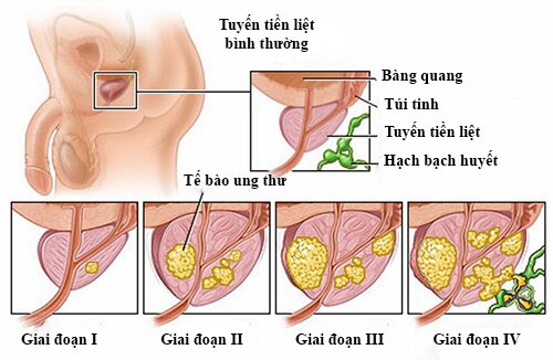 Ung thư tuyến tiền liệt - căn bệnh có thể chữa khỏi