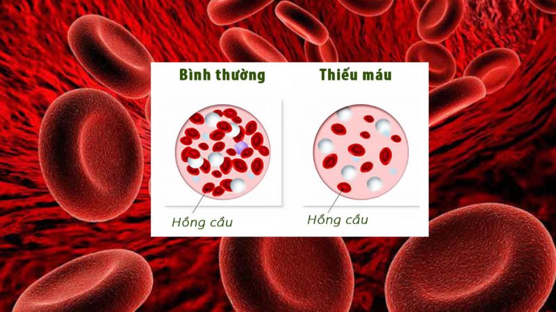 Thiếu vitamin B12 làm giảm lượng hồng cầu được tạo ra gây thiếu máu