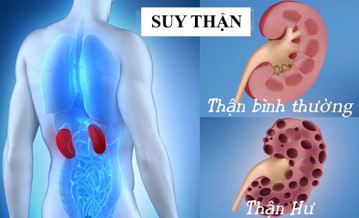 Có 3 dấu hiệu này, thanh niên 24 tuổi ở Phú Thọ đi khám bàng hoàng phát hiện suy thận giai đoạn cuối- Ảnh 4.