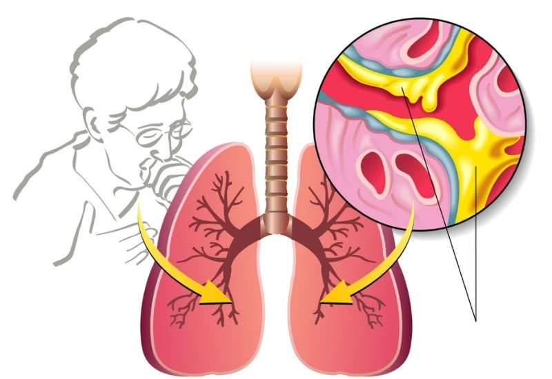 Ambroxol có công dụng giúp long đờm hiệu quả