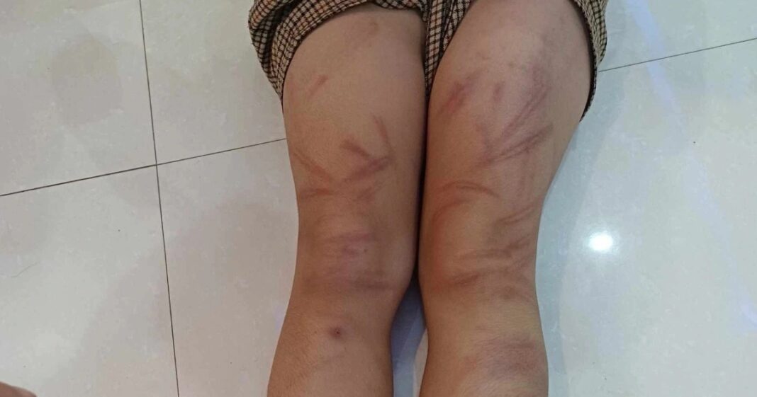 Xác minh nhiều trẻ mầm non bị đánh bầm tím cơ thể