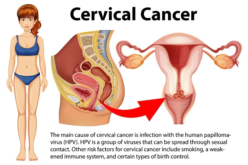  Virus HPV là nguyên nhân của hơn 95% trường hợp ung thư cổ tử cung