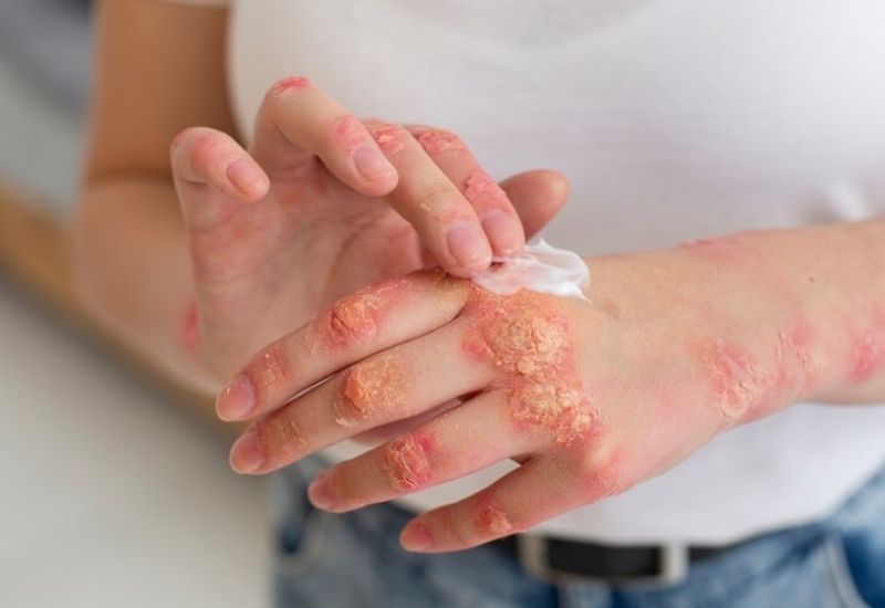 Điều trị eczema bằng hydrocortisone