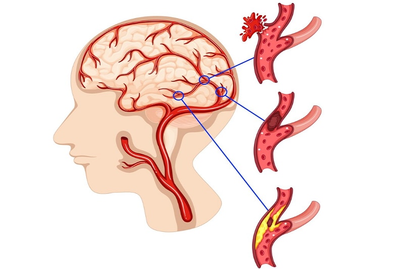 Mô phỏng về sự hình thành cơn nhồi máu não