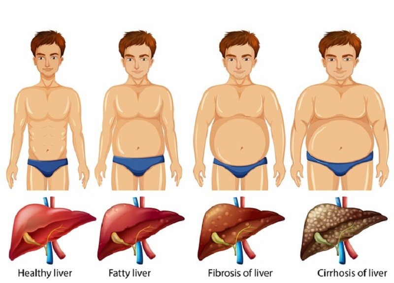 Chỉnh men gan cao theo cách tự nhiên tại nhà không dùng thuốc - Ảnh 1.