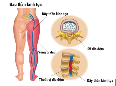 Đau thần kinh tọa - Nguyên nhân và cách hỗ trợ cải thiện- Ảnh 1.