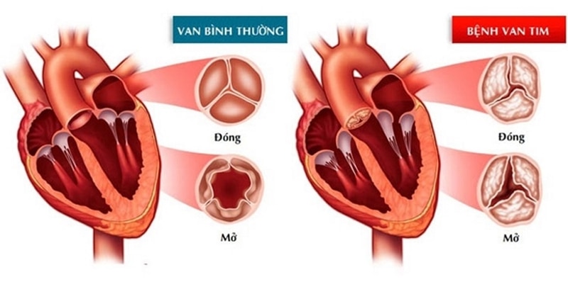 Hình ảnh minh họa van tim bình thường và van tim bị hở