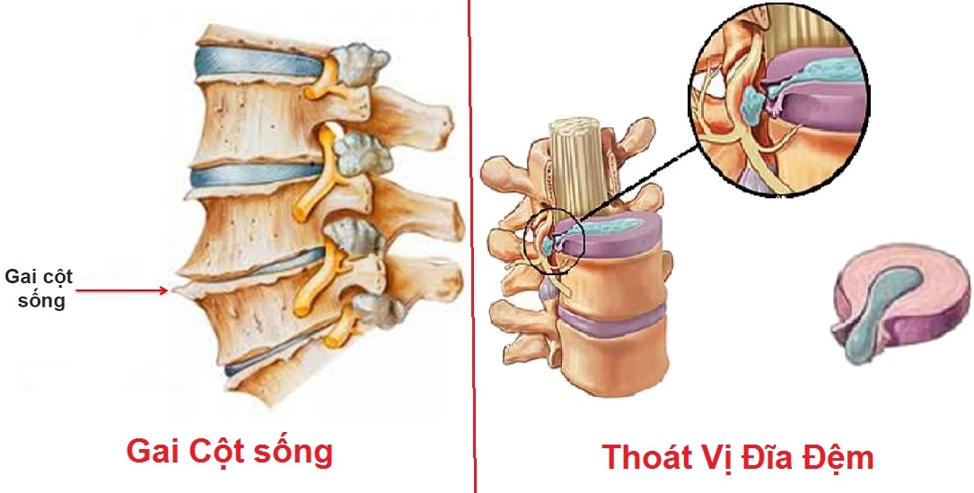 Thoát vị đĩa đệm là tình trạng nhân nhầy đĩa đệm ở giữa các đốt sống thoát ra khỏi những thớ sợi bao quanh bên ngoài.