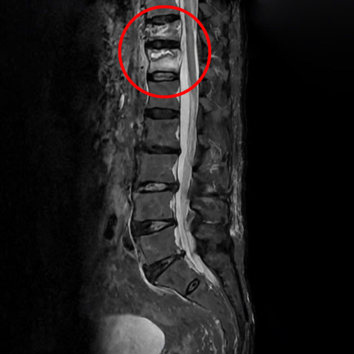 Kết quả phim chụp đốt sống T11, T12 bị vỡ, xẹp của cụ ông 96 tuổi.