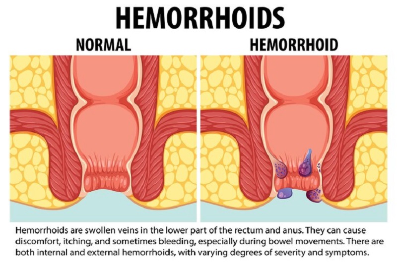 What causes anal itching and what should be done to fix it? Vietnam.vn