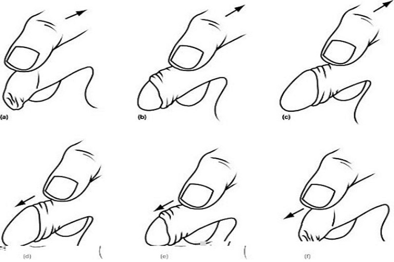 Mô phỏng các bước cần thực hiện đối với cách lột bao quy đầu tại nhà