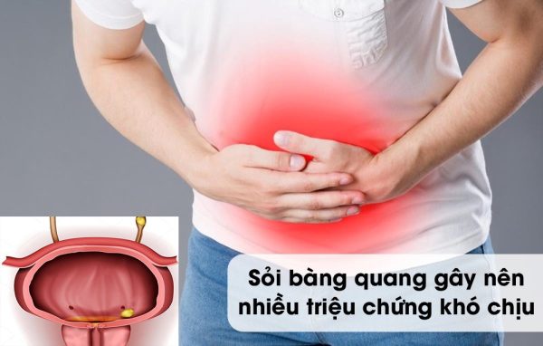 Người đàn ông 49 tuổi ở Phú Thọ nhập viện gấp, tăng nguy cơ suy thận do sỏi bàng quang gây tắc nghẽn đường tiểu - Ảnh 3.