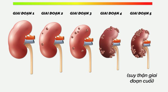 Suy thận độ 3 gây tiểu đêm nhiều lần, chân phù to – Cách hỗ trợ nào hiệu quả?- Ảnh 1.