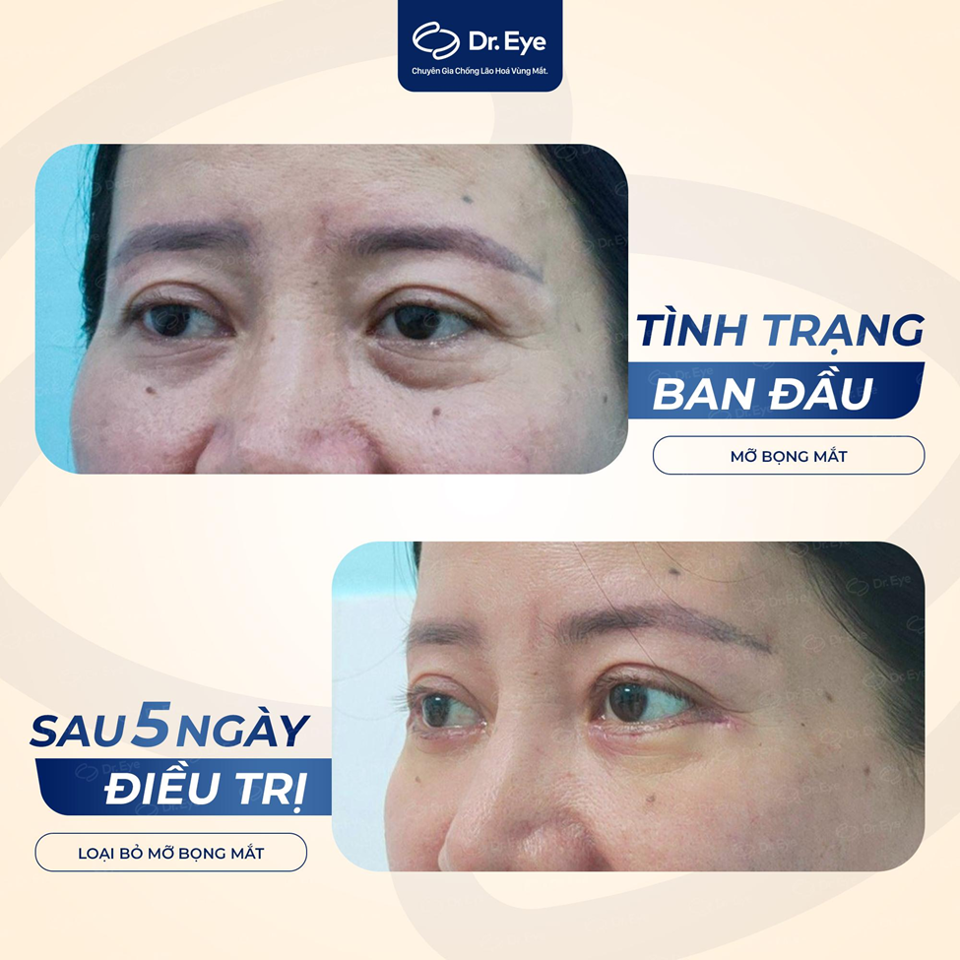 Tạm biệt đôi mắt già nua và buồn rầu chỉ sau 5 ngày điều trị bọng mắt tại Dr. Eye.