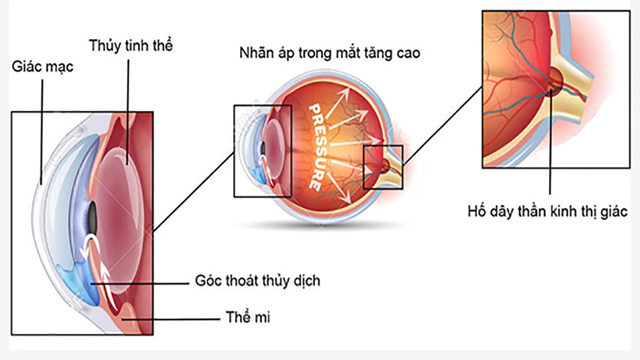 6 bước ngăn ngừa tăng nhãn áp gây hại thêm cho thị lực- Ảnh 1.