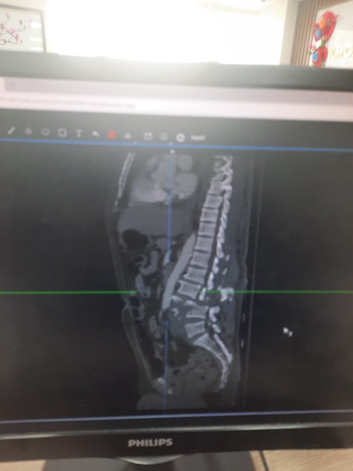 Hình ảnh phim chụp bệnh nhân gãy vỡ đốt sống L3,L4. (Ảnh: PV)