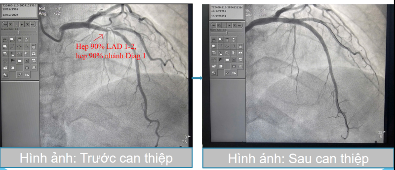 Người phụ nữ 62 tuổi ở Quảng Ninh bất ngờ phải đặt 2 stent mạch vành từ dấu hiệu nhiều người Việt bỏ qua - Ảnh 3.