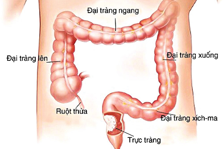 Ung thư đại trực tràng, ai cần tầm soát sớm?- Ảnh 1.