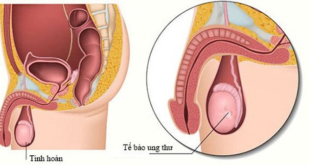 Bé trai 11 tuổi đã mắc ung thư tinh hoàn, chuyên gia cảnh báo dấu hiệu phát hiện sớm bệnh - Ảnh 1.