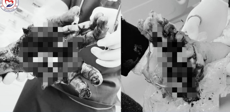 Kịp thời cứu chữa nam thanh niên bị dập nát 2 tay nghi do pháo nổ tự chế -0