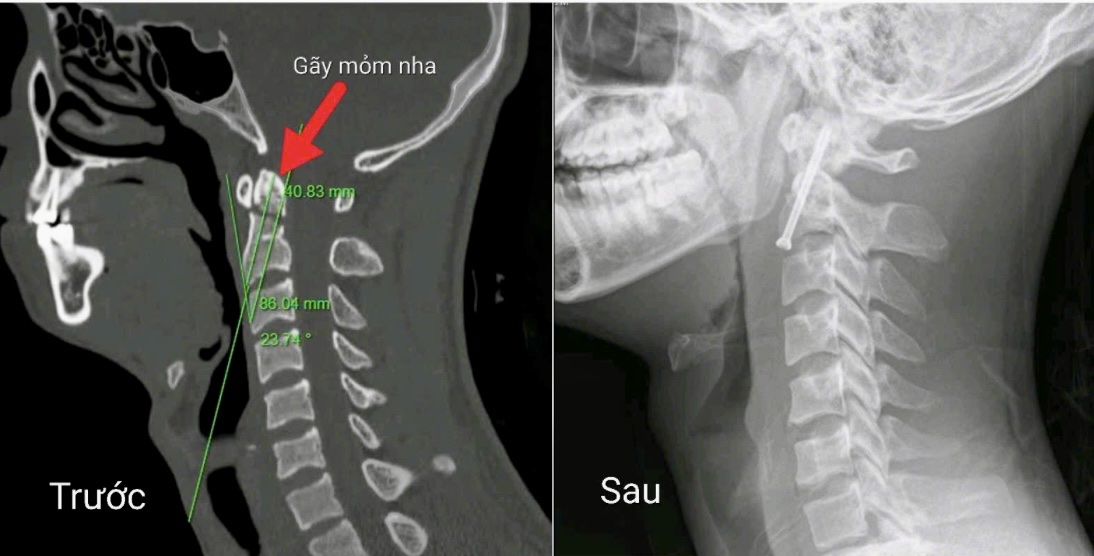 Phẫu thuật nội soi điều trị thành công ca gãy cột sống cổ phức tạp- Ảnh 1.